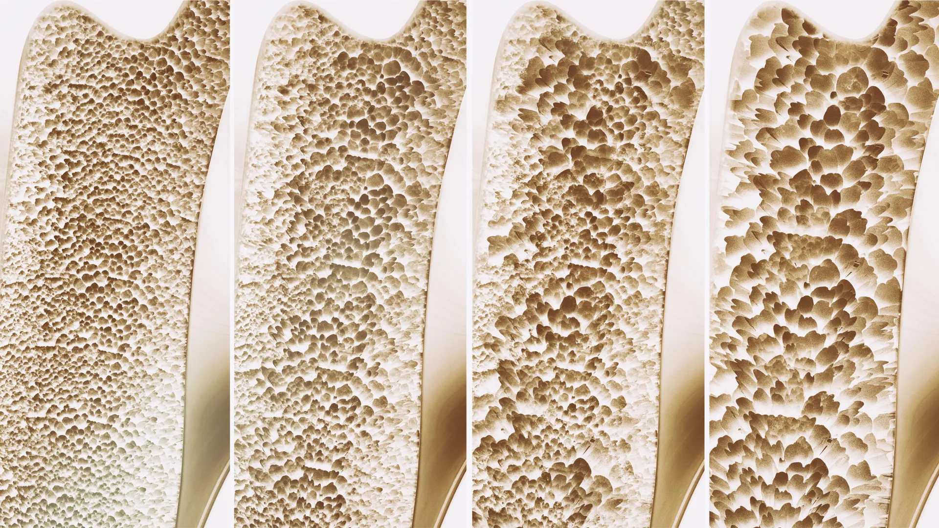 Knochenaufbauender Rezeptor als potenzielles Mittel gegen Osteoporose identifiziert