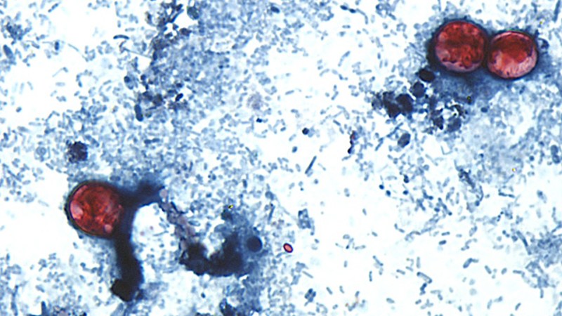 Cyclospora Outbreak Causes Diarrhea Across the U.S.