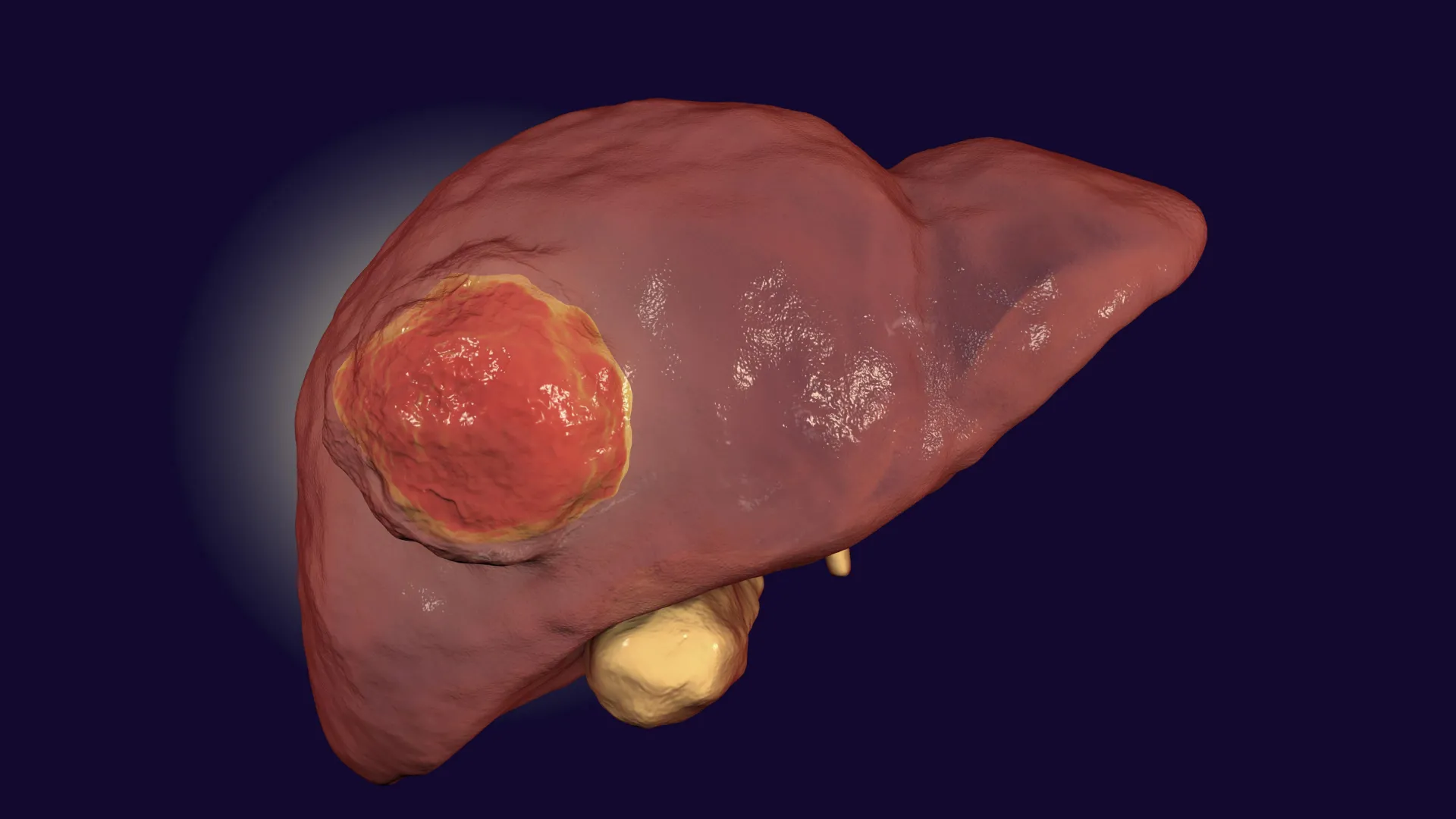 Un medicamento aprobado por la FDA podría ayudar finalmente a que la inmunoterapia derrote un cáncer hepático raro