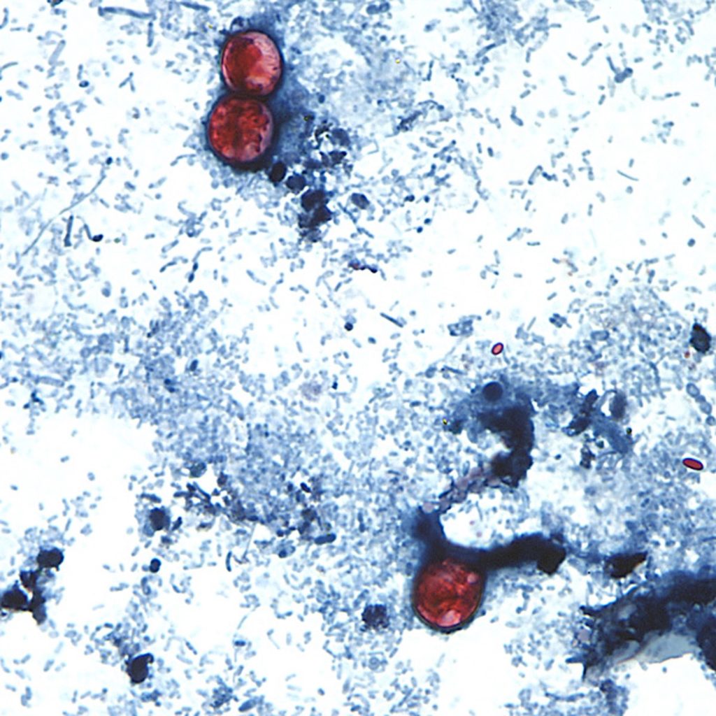 FDA Reassesses Cyclospora Findings as Multistate Lettuce Outbreak Persists