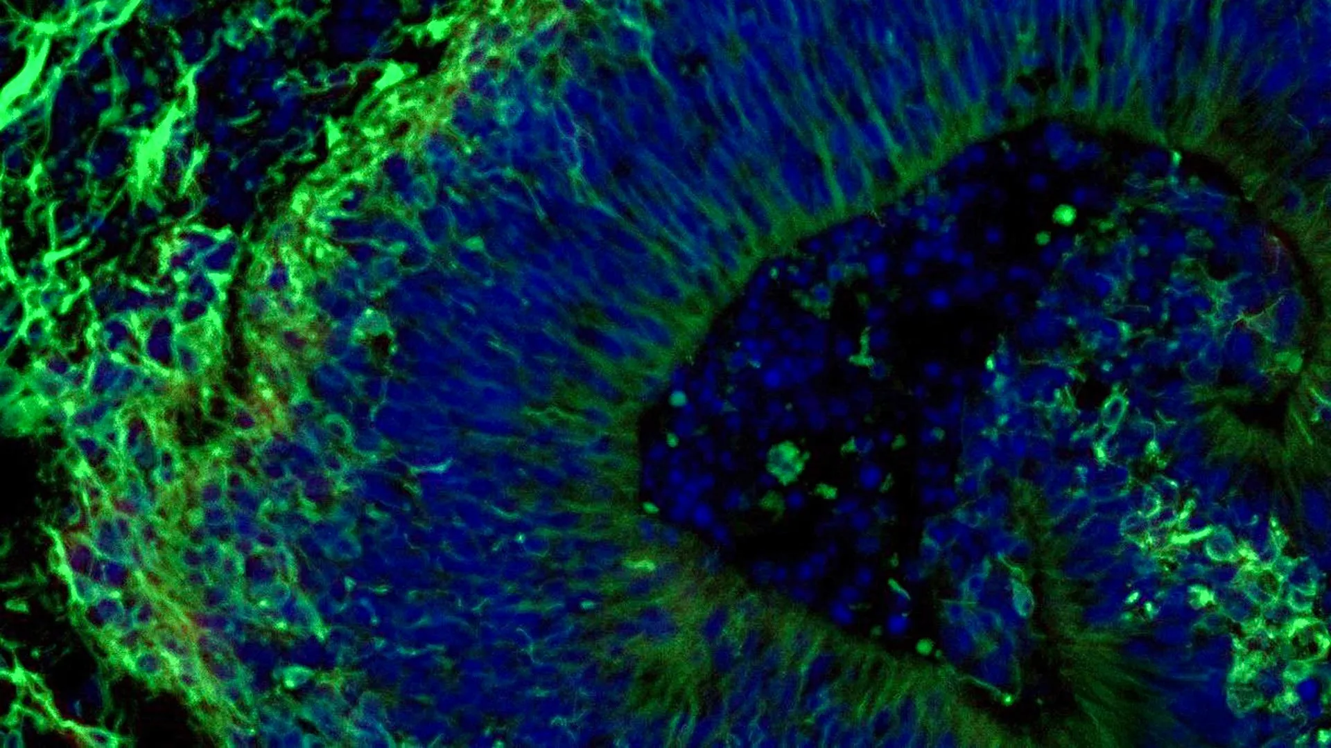 Miniature Brains May Predict Alzheimer’s Treatment Success