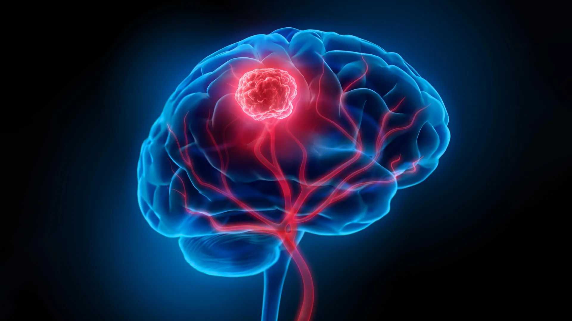 Nanoparticles Show Promise in Treating Deadly Brain Cancer