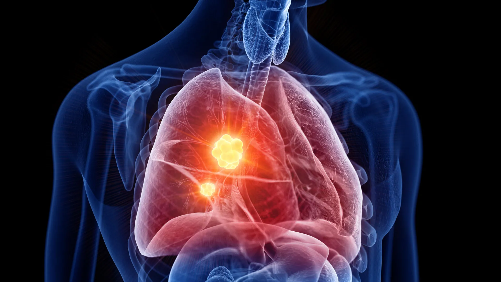 Neues Medikament zeigt vielversprechende Ergebnisse bei der Behandlung von Mesotheliom