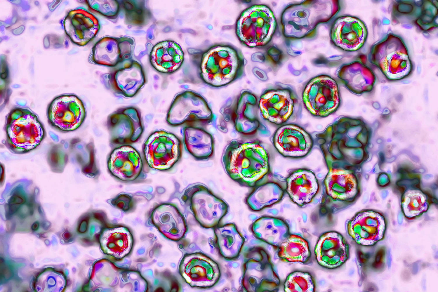 Pennsylvania Measles Outbreak Linked to Four Deaths, Including Three Unvaccinated Individuals
