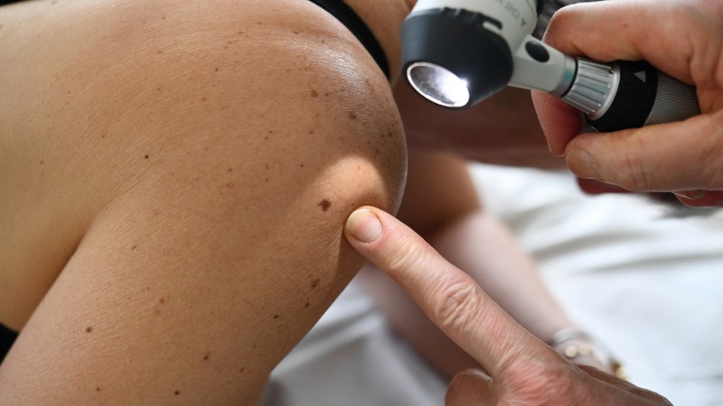 Personalized Cancer Vaccine Shows Promise Against Melanoma