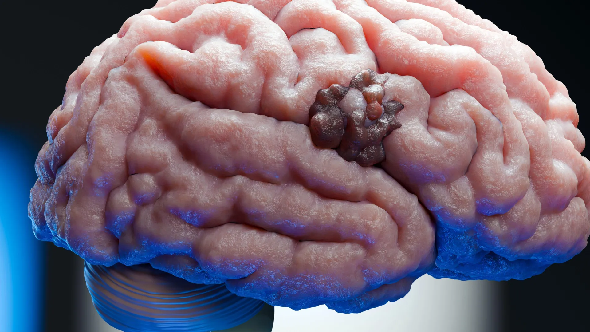 Scientists Identify Potential Weak Spot in Deadly Brain Cancer