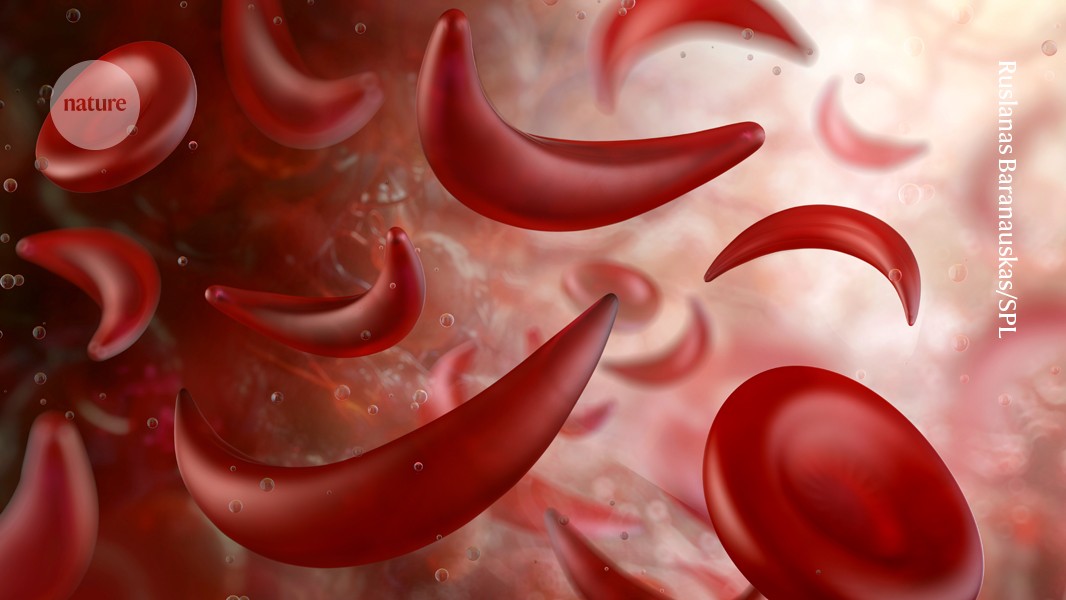 Sickle Cell Disease Linked to Prematurely Aged Stem Cells in Mice