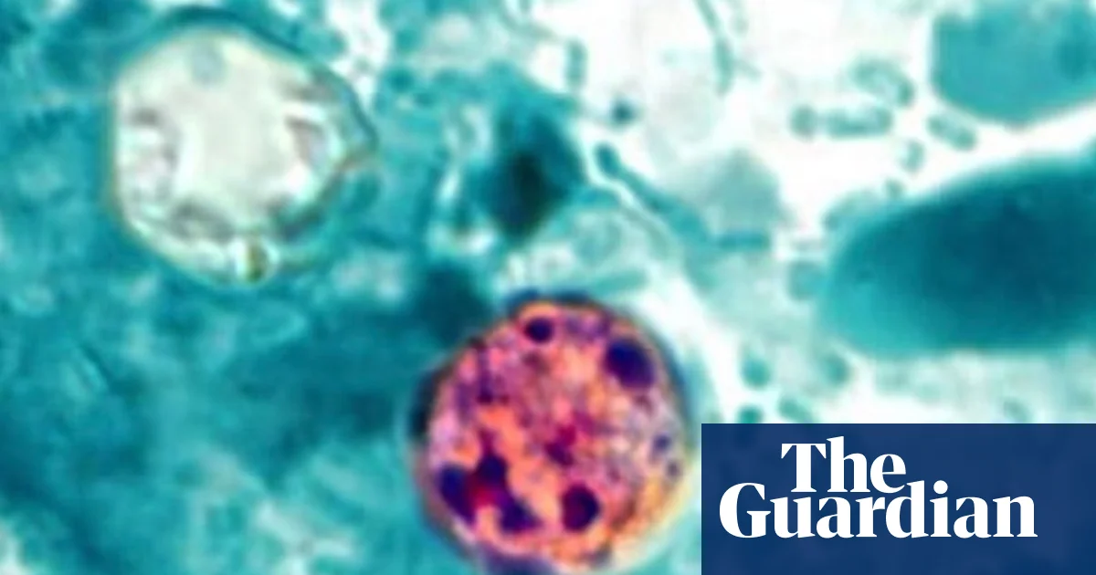 Two Deaths Linked to Cyclosporiasis Outbreak in Michigan, First U.S. Fatalities